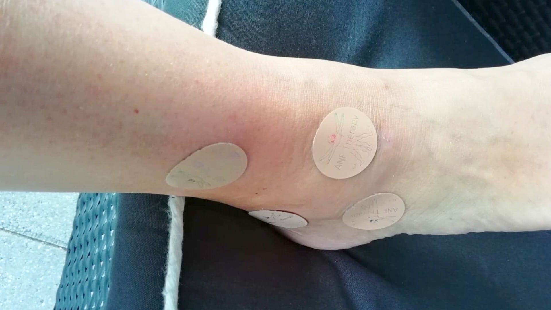 Achilles Heel Pain Bursitis