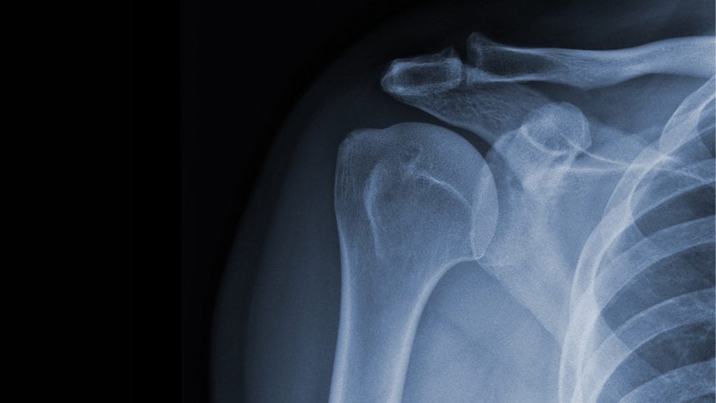 Calcific Tendonitis