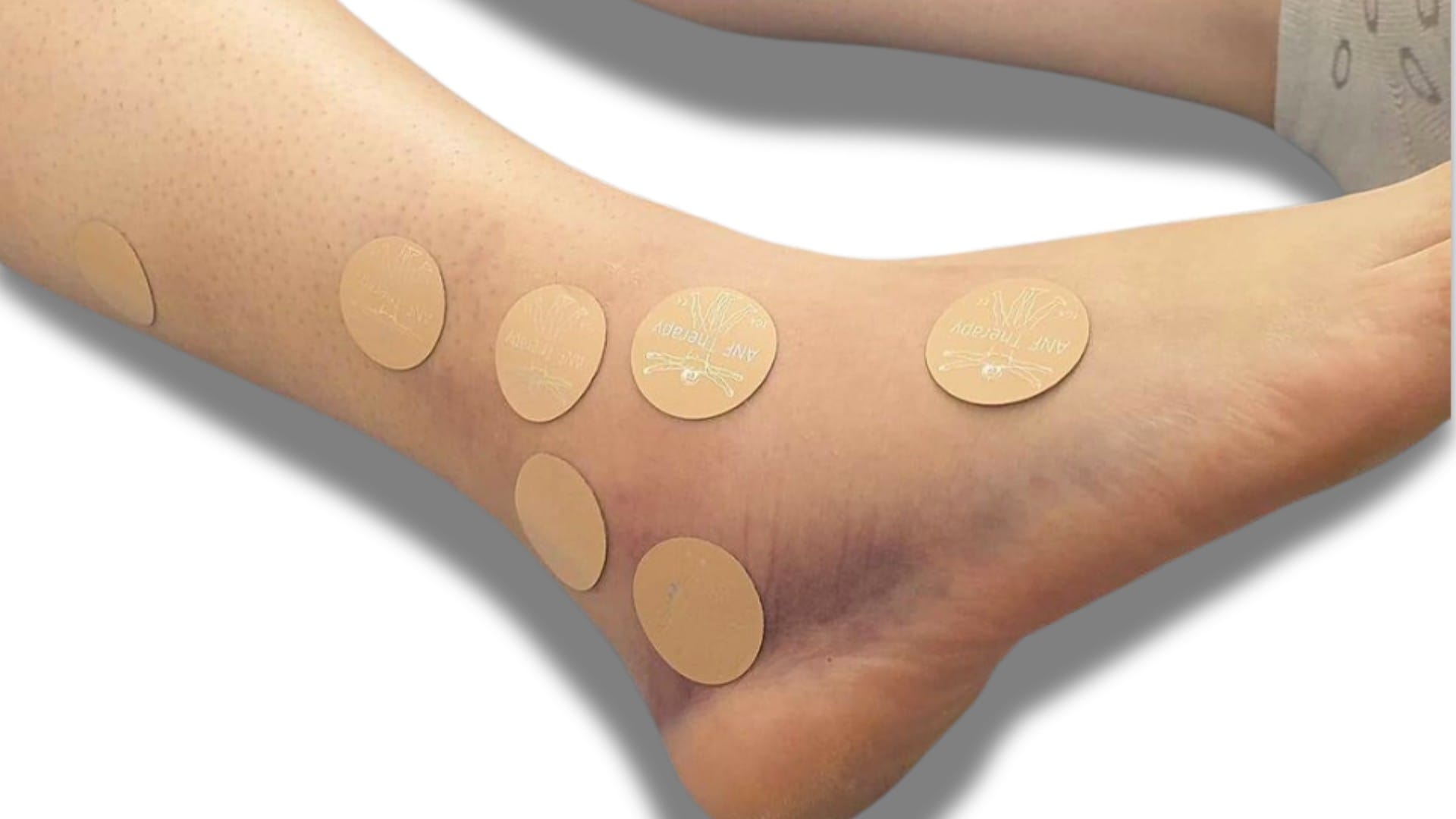 Sever’s Disease Achilles Tendonitis
