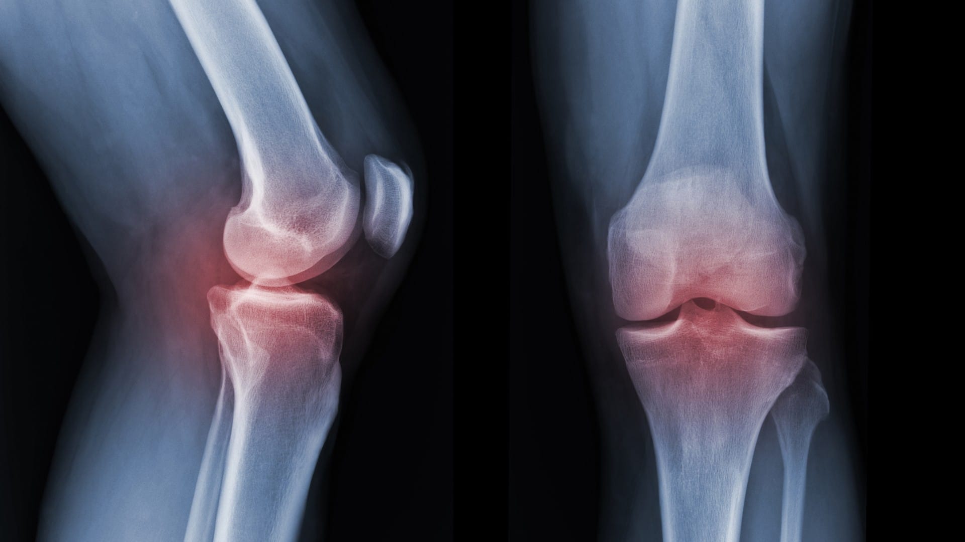 What Happens When You Sprain Your Knee