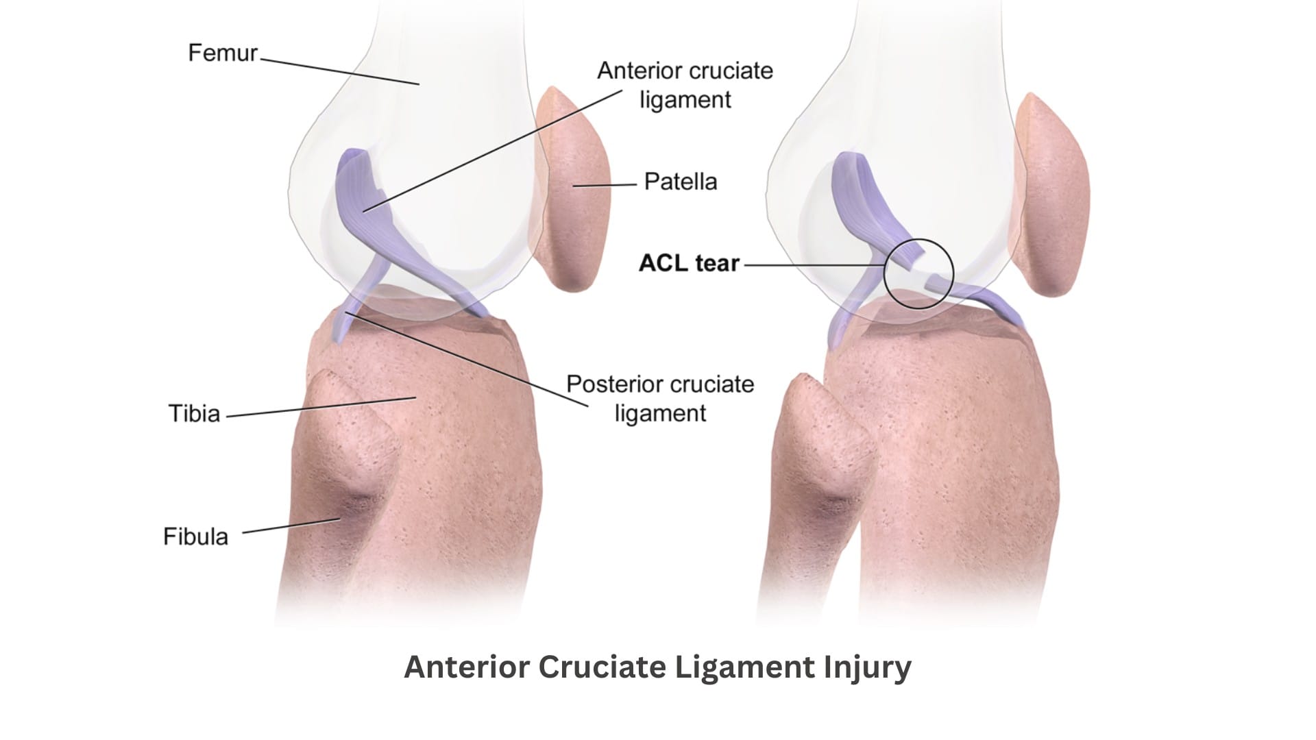 What is Arthritis