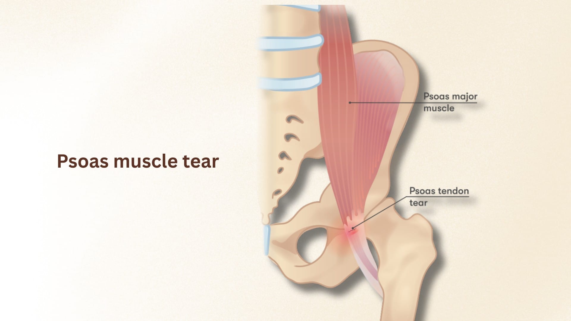 psoas muscle tear