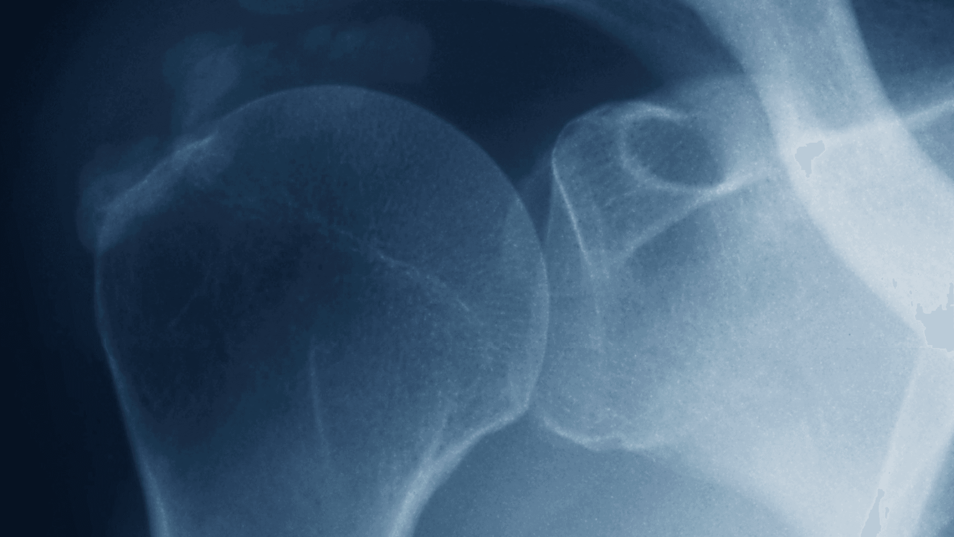 Understanding Calcific Tendinitis