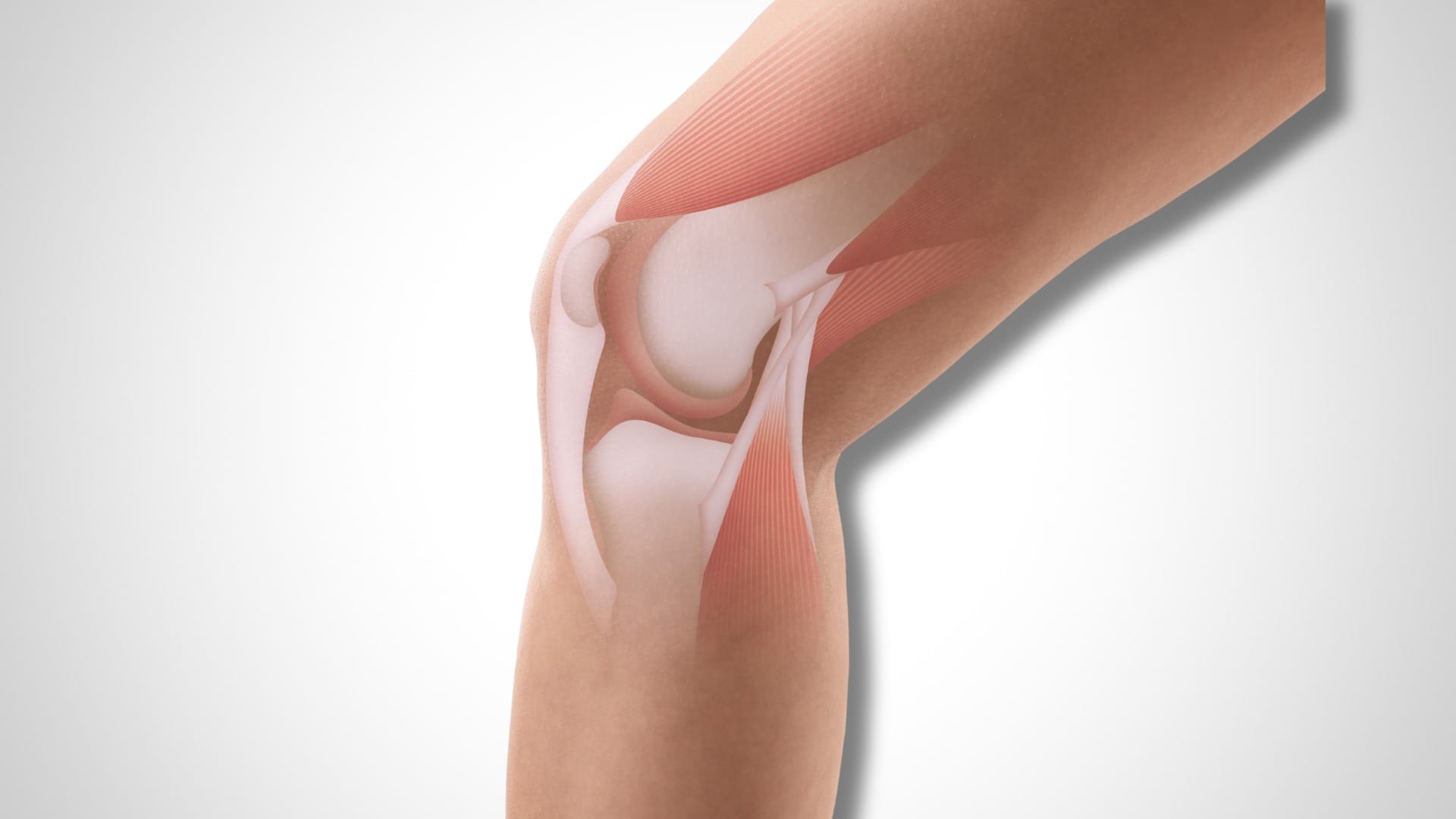 Pain Medial Collateral Ligament