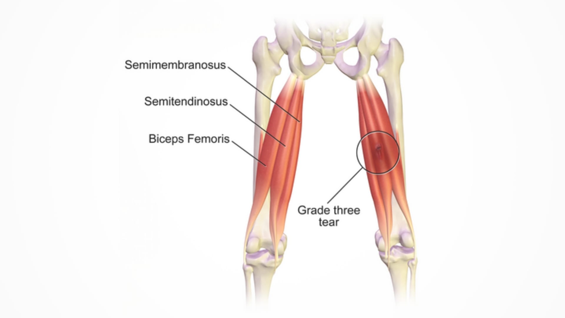 Understanding the Hamstring Muscles