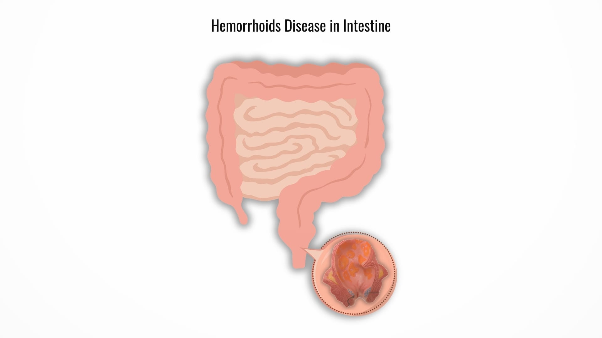 What Are Hemorrhoids
