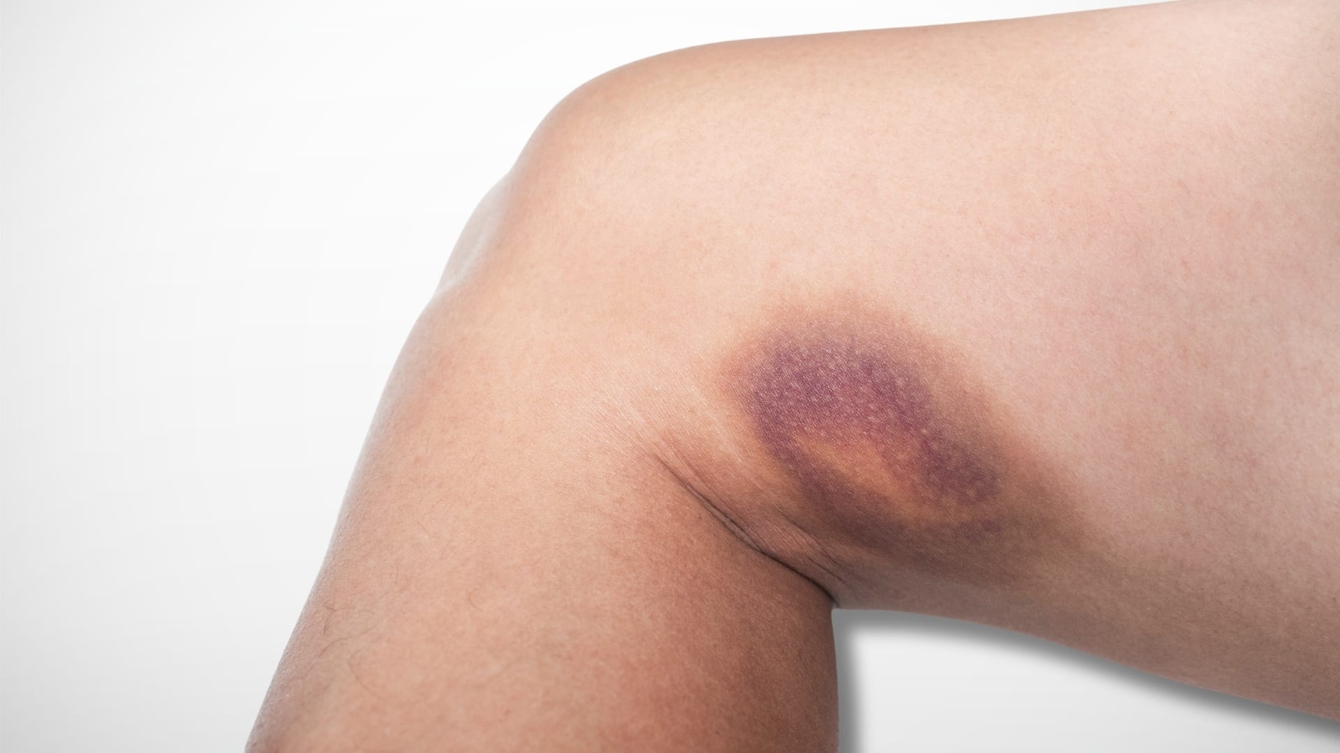 Why Does Bruising Occur